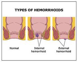 Image result for Hemorrhoid