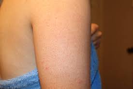 Focusing on red bumps on arms, specifically on hands and fingers, bumps can appear to you when your skin gets in contact with a foreign substance such as chemicals, dust particles, poison and pollen grains from plants, it can develop into an irritation that can result to red itchy and bumpy skin. This Is The Reason You Re Getting Red Bumps On Your Arms Smooth