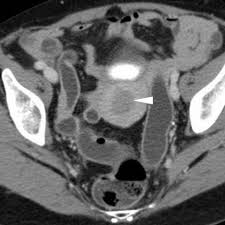 Endometriosis is a condition in which the tissue that lines the uterus also grows outside the uterus. Pelvic Endometrial Carcinoma Recurrence Mri Including Diffusion Weighted Imaging Eurorad