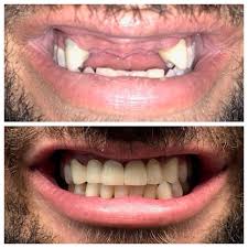 Lively Dental Crowns Before And After Products Dentalimplants Dentalcrownsbeforeandafterfit Dental Implants Cost Dental Crowns Tooth Extraction Aftercare