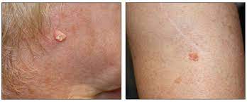 Understanding liver cancer is important if you want to develop an effective treatment plan and live a long and healthy life. Skin Cancer Treatment Pdq Patient Version National Cancer Institute