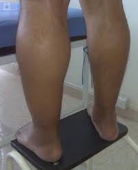 En la trombosis venosa superficial el trombo se forma dentro de las venas superficiales que se encuentran directamente debajo de la superficie de la piel. Tromboflebitis Y Varices En Las Piernas