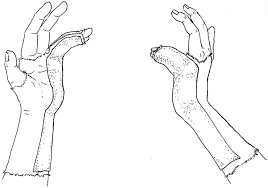 Check spelling or type a new query. Basic Principles Of Splinting In The Emergency Department Chapter 14 Sports Medicine For The Emergency Physician
