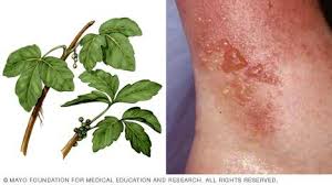 The oil travels throughout your bloodstream, meaning it can show up anywhere on your skin and it may even take a couple of days. Treat Poison Ivy Oak Dermatitis Online Web Doctors Online