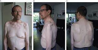 Jun 14, 2021 · the pictures below show what brain lesions may look like on an mri scan. Progressive Muscular Atrophy Case 4 Neuromuscular Disease