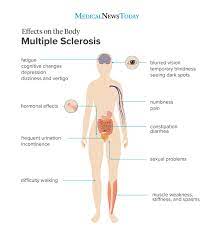 They can be mild, or more severe. What Is Multiple Sclerosis And How Can An Exercise Routine Help