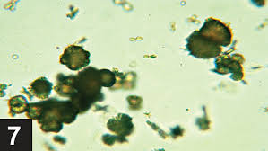 Ammonium Urate Urolithiasis Clinician S Brief