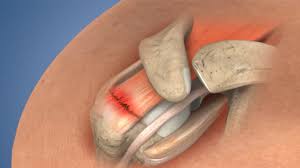 Image result for Rotator Cuff Injury