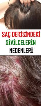 Sac Derisindeki Sivilcelerin Nedenleri Www Vipbakim Com Sac Saglikli Sac Dogal Sac
