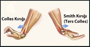 El Bilegi Kiriklari Distal Radius Ulna Kiriklari Fizyoterapi Anatomi