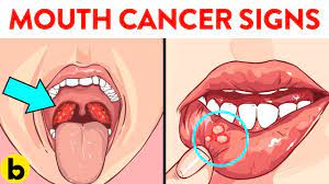 Mouth cancer can occur anywhere in the mouth, including the lips. 6 Early Signs Of Mouth Cancer You Should Not Ignore Youtube