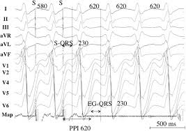 The interactive form of the currency calculator ensures navigation in the actual quotations of world currencies according to open exchange rates and displays the information in a. 2019 Hrs Ehra Aphrs Lahrs Expert Consensus Statement On Catheter Ablation Of Ventricular Arrhythmias Executive Summary Springerlink