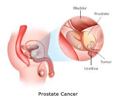 Prostate cancer is the most common cancer in men after skin cancer, so it's important to understand the basics of the disease, as well as the risk factors. Dr Swati Shah Uro Oncologist Best Prostate Cancer Surgeon In Ahmedabad