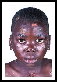 Impetigo Framed Art Prints for Sale