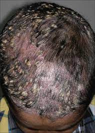 Repeated scratching of the scalp due to itch (usually reversible). Pityriasis Amiantacea Causes Symptoms Diagnosis Treatment