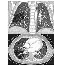 Center for pure and applied mathematics. Congenital Pulmonary Airway Malformations Cpam The Abnormality Formerly Known As Ccam Paediatricfoam