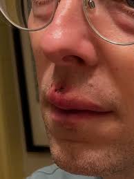 Great to be BACK at the BSO for Tosca this week (after missing last  weekend's concerts due to some chipped teeth, now fixed thanks to my great  dental practice, and upper lip