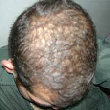 Telogen effluvium (te) is the most common cause of diffuse hair loss in adult females. Hair Treatment Services Alopecia Areata Stage2 Alopecia Totalis Entire Scalp Hairloss Female Patern Baldness Diffuse Alopecia Scaring Alopecia Traction Alopecia