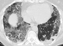 Bacterial pneumonia is an infection of your lungs caused by certain bacteria. Http Sppt Org Br Wp Content Uploads 2020 04 Covid 19 1 Pdf