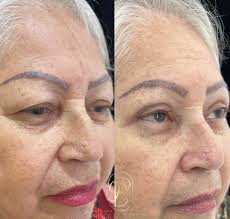 ⚜️Blefaroplastia Superior, sequência de um resultado incrível 🤍 . Essa  cirurgia proporciona o rejuvenescimento do olhar e face. Além disso, em  alguns casos também melhora o campo de visão, isso mesmo! . .