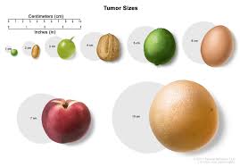 childhood extracranial germ cell tumors treatment pdq