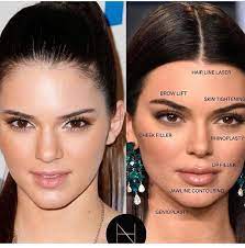How to become a model faqs. How To Become An Instagram Model Kendal Jenner Before And After Surgery Facial Fillers Kendall Jenner Plastic Surgery Face Surgery