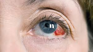 November 3 at 2:57 pm ·. What Causes A Broken Blood Vessel In The Eye