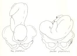 Image result for Shoulder Presentation