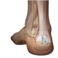 Bone spurs develop when the body lays down extra layers of bone in an attempt to protect itself from repetitive friction or stress. Achilles Insertional Debridement Spur Removal Repair Stirling Nedlands