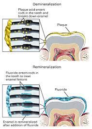 Enamel Remineralization Prospect Dental Arlington Heights Chicago General Dentistry Implants Cosmetic Dentistry