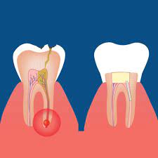 Root Canal Sonora Dentist Jeff Berger Artisan Dental Lab