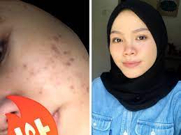 3 langkah penjagaan kulit muka berjerawat: Gadis Ini Kongsi Tip Jaga Kulit Wajah Guna Produk Skincare Yang Sesuai Remaja