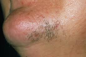 Is it just mother nature playing a sick joke on us? Hirsutism Clinical Advisor