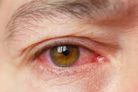 Image result for Uveitis