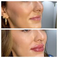This knockout is approaching a birthday milestone. A little refreshed toxin  and a dust of filler in her lips for her big moment 😍💕 @slcmedspa