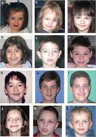 Characterization Of Potocki Lupski Syndrome Dup 17 P11 2p11 2 And Delineation Of A Dosage Sensitive Critical Interval That Can Convey An Autism Phenotype Sciencedirect
