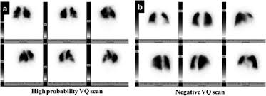 Image result for Ventilation Perfusion Scan
