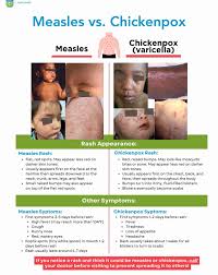 Image result for measles