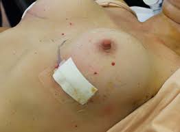 Besides, it might even take full six months for the scars to disappear. Breast Augmentation Sydney Post Op Instructions