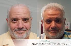 Discover 29 Natural Transplants, Hair Restoration Clinic and hair doctor  ideas