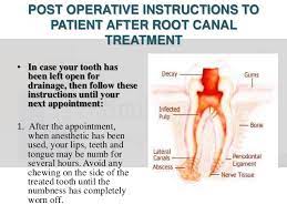 But what can we eat after a root canal surgery? Postoperative Instructions After Root Canal Treatment