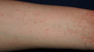 Image result for scabies human bites
