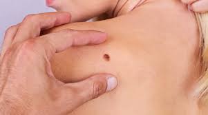 Being armed with information is vital to begin the fight. 5 Factors That Predispose You To Melanoma
