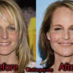 Did jennifer jason leigh use plastic surgery? Jennifer Jason Leigh Plastic Surgery Before And After Botox Pictures