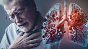 Virus sincitial respiratorio amenaza durante épocas de fiestas