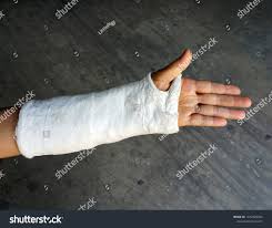 Image result for Short Arm Cast