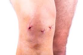Recovery After Arthroscopy Knee Surgery