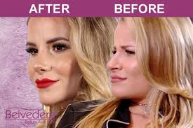 We did not find results for: A Brand New Nose For Towies Georgia Kousoulou The Belvedere Clinic Cosmetic Surgery London Essex Kent