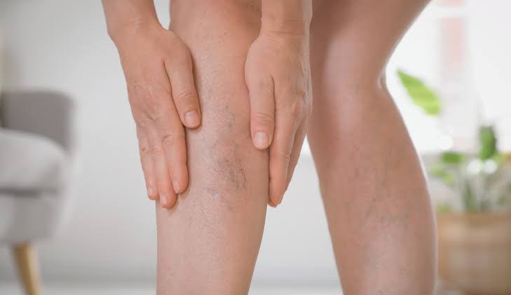 Pain Relief from Varicose Veins - Vein Solutions