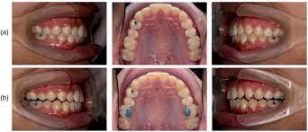Foods that you need to bite into forcefully such as apples, raw carrots and corn. Scielo Brasil Immediate Effects Of Temporary Bite Raising With Light Cured Orthodontic Band Cement On The Electromyographic Response Of Masticatory Muscles Immediate Effects Of Temporary Bite Raising With Light Cured Orthodontic Band Cement On